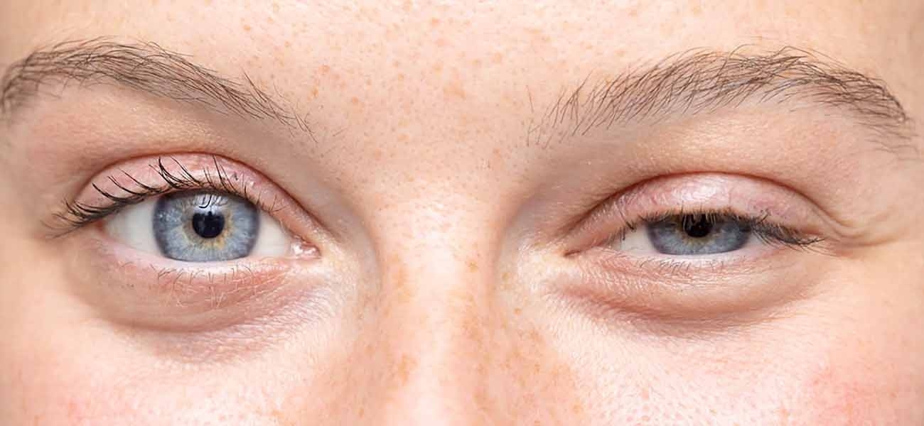 Myastenia Gravis Nedir Myastenia Gravis Belirtileri Ve Tedavisi Saglik Rehberi Denizli Ozel Cerrahi Hastanesi