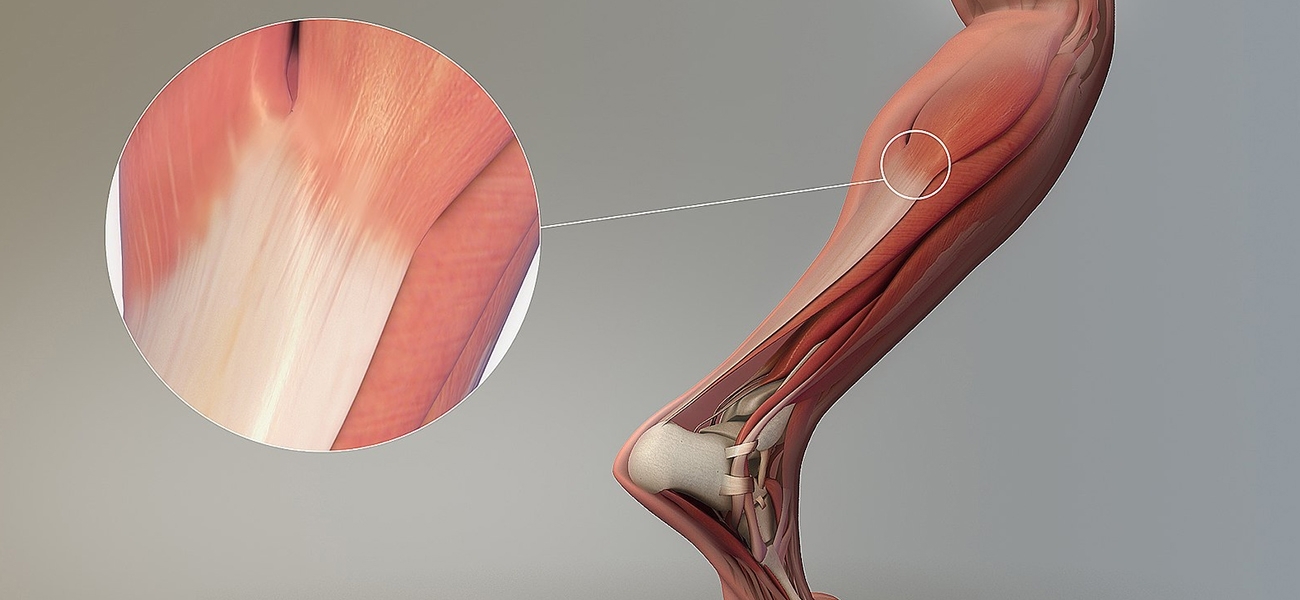 Tendon Nedir Tendon Yaralanmalari Ve Tedavi Yontemleri Saglik Rehberi Denizli Ozel Cerrahi Hastanesi Tendon Nedir Tendon Yaralanmalari Ve Tedavi Yontemleri Saglik Rehberi Denizli Ozel Cerrahi Hastanesi