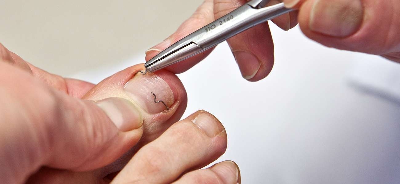 tirnak batmasi batik tirnak nedir nedenleri ve tedavisi saglik rehberi